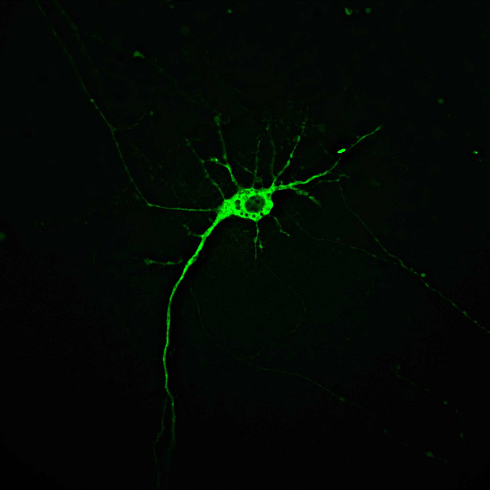 Illuminating the progression of Huntingtonās disease
