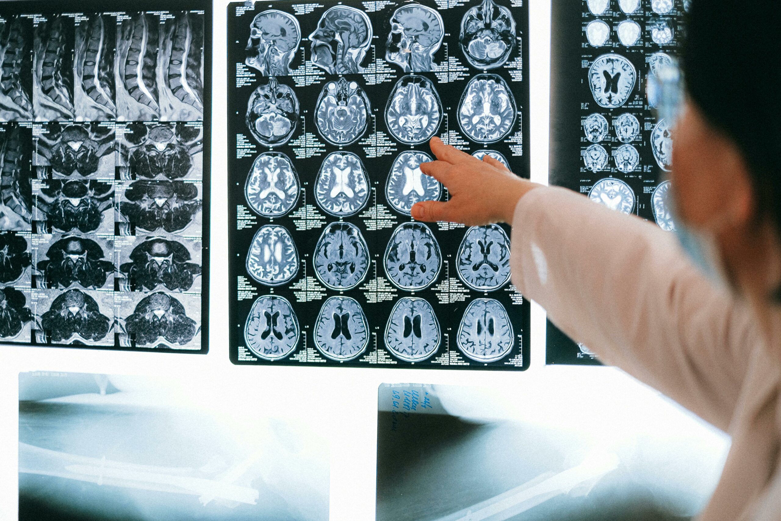 2025 HDBuzz Prize: MR-âwhyâ am I feeling this way? How MRI is helping us understand why people with HD may sometimes be unaware of their symptoms